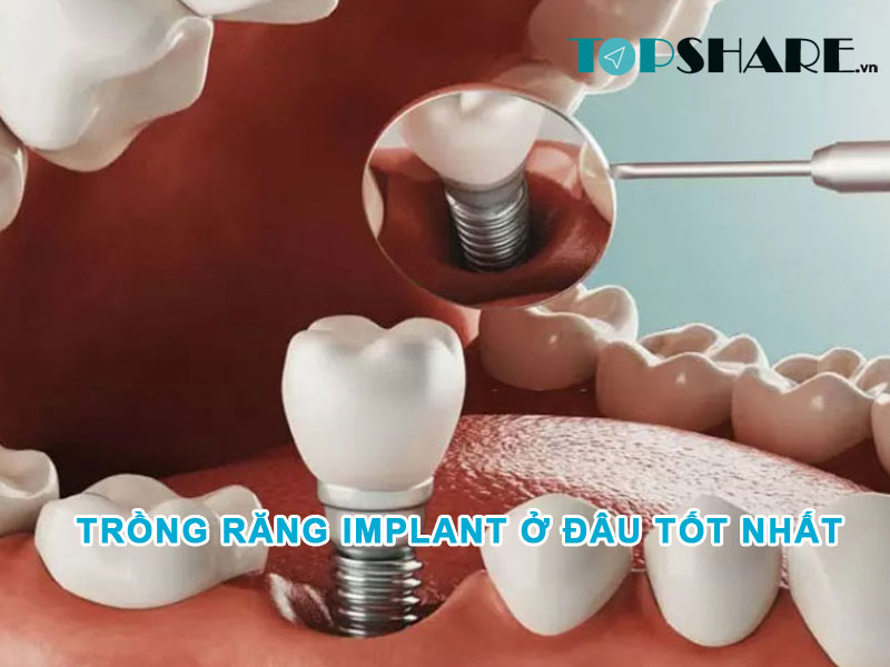 <strong>Trồng răng Implant ở đâu tốt nhất? Top 6 tiêu chí xác định địa chỉ trồng răng Implant uy tín</strong> 6 Trồng răng Implant ở đâu tốt nhất?