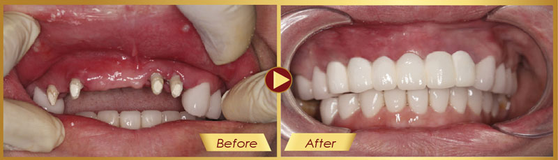 <strong>Trồng răng Implant ở đâu tốt nhất? Top 6 tiêu chí xác định địa chỉ trồng răng Implant uy tín</strong> 10 <strong>Trồng răng Implant ở đâu tốt nhất? Top 6 tiêu chí xác định địa chỉ trồng răng Implant uy tín</strong> 2