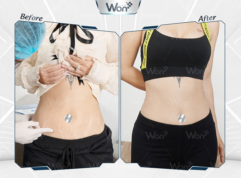 Trị rạn da bằng công nghệ Matrix Plus tại Won Clinic có tốt như quảng cáo? 7 Công nghệ Matrix Plus mang đến hiệu quả cải thiện trên 80% tình trạng rạn da