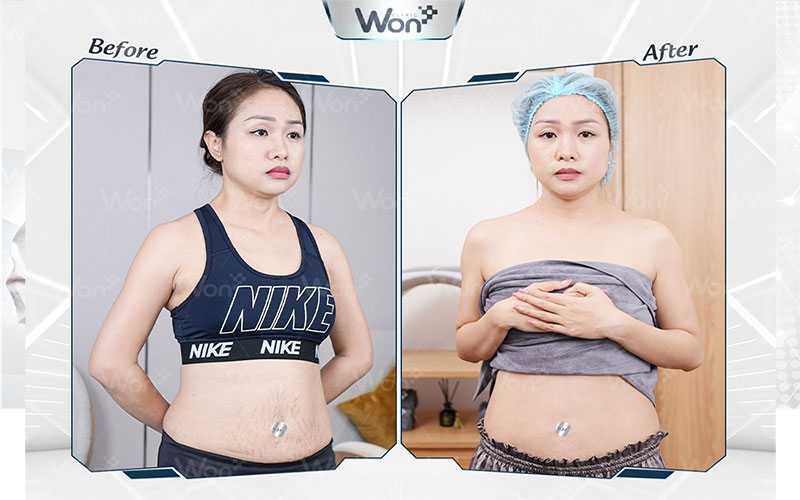 Trị rạn da bằng công nghệ Matrix Plus tại Won Clinic có tốt như quảng cáo? 6 Công nghệ Matrix Plus - Giải pháp tối ưu giúp loại bỏ các vết rạn bẩm sinh, rạn sau sinh
