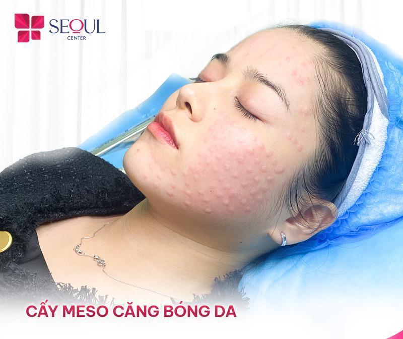 Tiêm Meso bao nhiêu tiền? Tiêm Meso ở đâu an toàn và uy tín? 6 Tiêm meso giúp trẻ hóa làn da, cải thiện các vết nám, tàn nhang