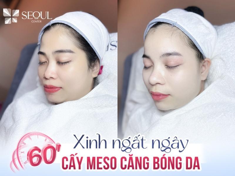 Tiêm Meso bao nhiêu tiền? Tiêm Meso ở đâu an toàn và uy tín? 10 Khách hàng sở hữu làn da trắng sáng, chắc khỏe nhờ tiêm meso tại Seoul Center
