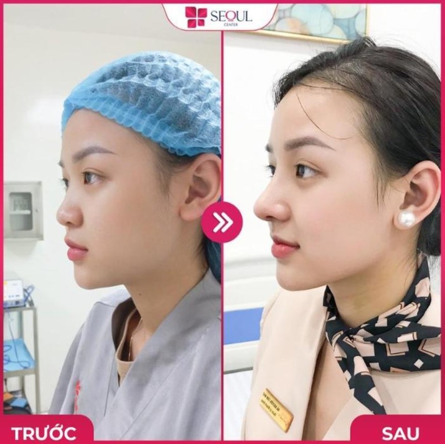 Nên nâng mũi bằng sụn tự thân hay nhân tạo thì tốt? 4 Nâng mũi bằng sụn tự thân được đánh giá cao hơn về mức độ hiệu quả