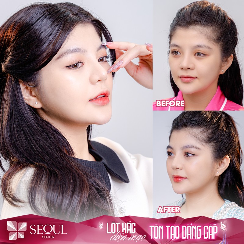 Nên nâng mũi bằng sụn tự thân hay nhân tạo thì tốt? 5 Nên nâng mũi bằng sụn tự thân hay nhân tạo thì tốt? 2