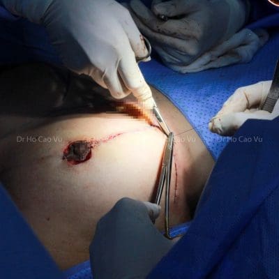 Phẫu thuật sửa sẹo dọc sau treo ngực sa trễ 11 Phẫu thuật sửa sẹo dọc sau treo ngực sa trễ 11