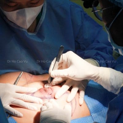 Phẫu thuật sửa sẹo dọc sau treo ngực sa trễ 10 Phẫu thuật sửa sẹo dọc sau treo ngực sa trễ 10