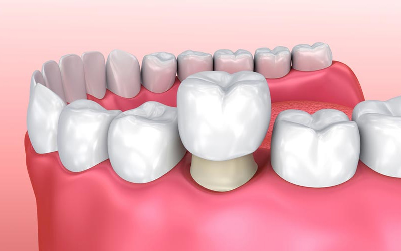 Có nên bọc răng toàn sứ giá rẻ không? Bọc răng sứ ở đâu uy tín? 6 Có nên bọc răng toàn sứ giá rẻ không? Bọc răng sứ ở đâu uy tín? 6